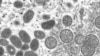 Monkeypox Virus Could Become Entrenched as New STD in US 